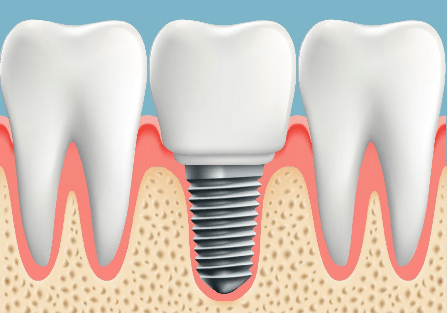 Dental Implant Newstead